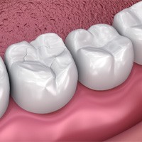 Digital illustration of tooth-colored filling in Huntington Beach 