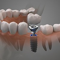 Illustration of an implant in a lower arch with faded background