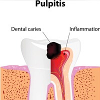 Diagram of teeth and pulpitis