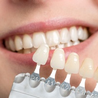 Woman smiling next to range of veneers shades