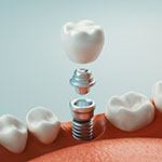 Crown being stacked on top of abutment and implant