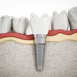 Dental implant post having integrated with jaw