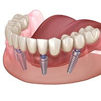All-on-4 implants supporting complete arch of teeth for lower jaw