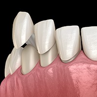 Illustration of porcelain veneers being placed on teeth