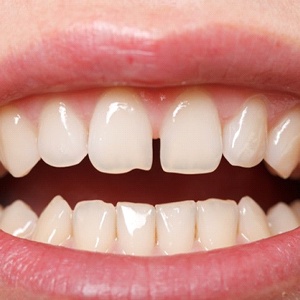 A person with gapped front tooth.