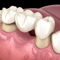 dental bridge replacing a single missing tooth