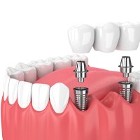 dental bridge being supported by two dental implants