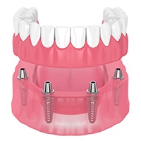 illustration of implant dentures for cost of dentures in Huntington Beach   