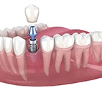 A single dental implant in Huntington Beach located in the lower arch of the mouth