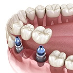 A digital image showing a dental implant bridge sitting in the lower arch in Huntington Beach