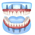 A digital scan of four dental implants on the lower and upper arches of the mouth and full dentures attached in Huntington Beach