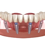 A digital image of All-On-4 dental implants in Huntington Beach located in the lower arch of the mouth