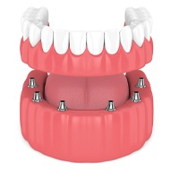 Implant dentures work in Huntington Beach