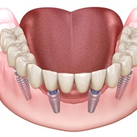 Implant dentures on the lower arch in Huntington Beach