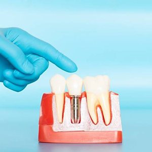 hand pointing to model of dental implants in Huntington Beach