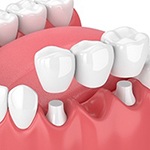 Diagram of dental implant bridge in Huntington Beach