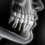 Diagram of dental implant after bone graft in Huntington Beach