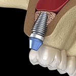 Diagram of dental implant after sinus lift in Huntington Beach