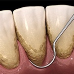 Diagram of gum disease treatment in Huntington Beach