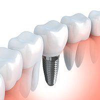 diagram of dental implants in Huntington Beach