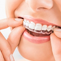 Close-up of woman’s mouth as she dons clear aligner