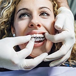 dentist putting Invisalign aligner on patient