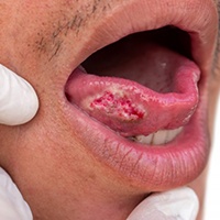 Close up of a patient’s tongue sore