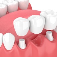 dental bridge replacing a single missing tooth