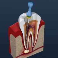 illustration of root canal therapy 
	The Benefits of Getting a Root Canal 
	
	