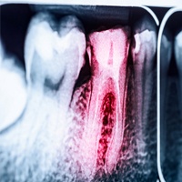 X-Ray of damaged tooth