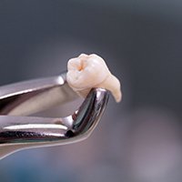 tooth extraction cost of root canal in Huntington Beach 