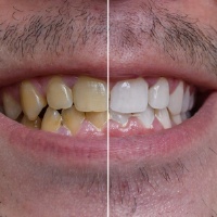 before and after teeth whitening