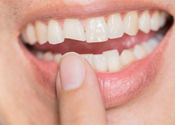Treating a broken tooth is an important way to preserve your oral health near Fountain Valley