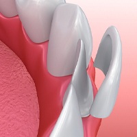 Illustration of veneer being placed on tooth