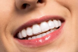 woman smiling wearing Invisalign braces