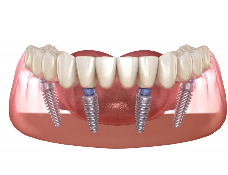 Four dental implants supporting a full denture