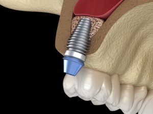 Model showing the basics of dental implants